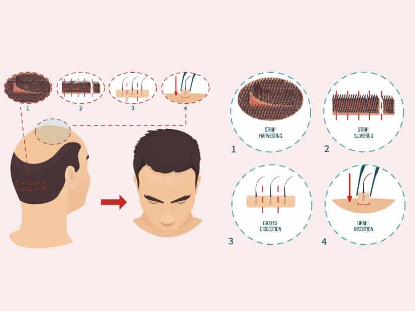 Hair-Transplant-Method-–-FUT-Technique-1