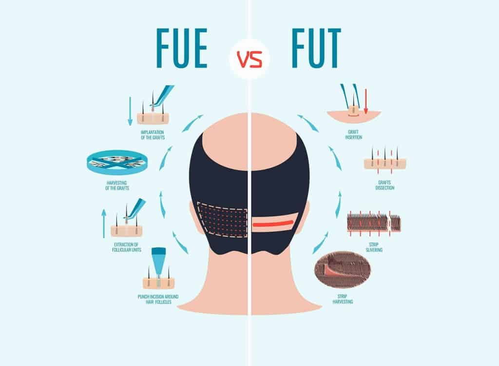 FUE Slit Hair Transplant | Sule Hair Transplant
