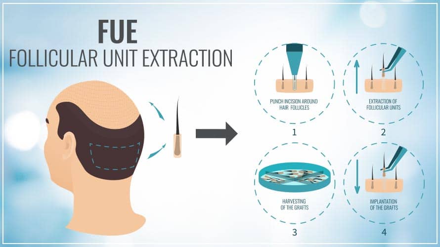 FUE (follicular unit extraction) What is FUE? | Sule Hair Transplant