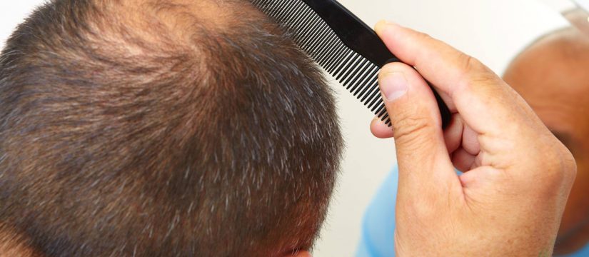 Is Your Hair Healthy Enough for a Hair Transplant