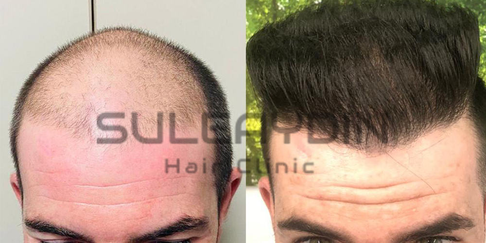 Hair Transplant Before & After Results - Şule Aydın Hair Clinic