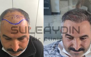 hair transplant turkey before after2