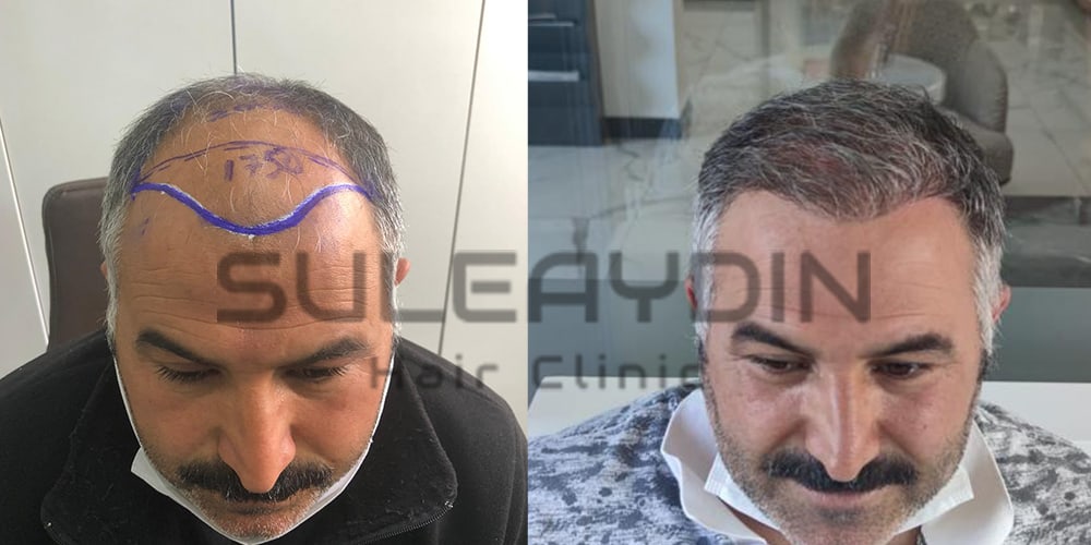 hair transplant turkey before after2